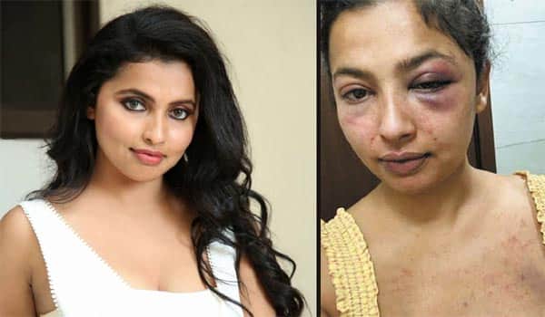 Anicka-Vikhraman-seriously-injured-when-her-boyfriend-attacked