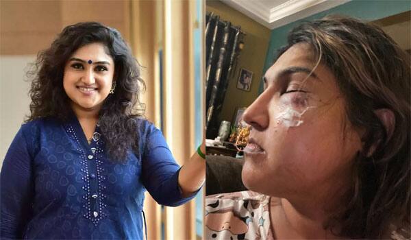 Vanitha-attacked-by-a-mysterious-person:-The-picture-of-her-injured-caused-a-sensation